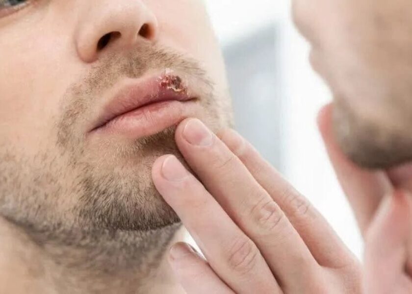 Blog-Cold Sores