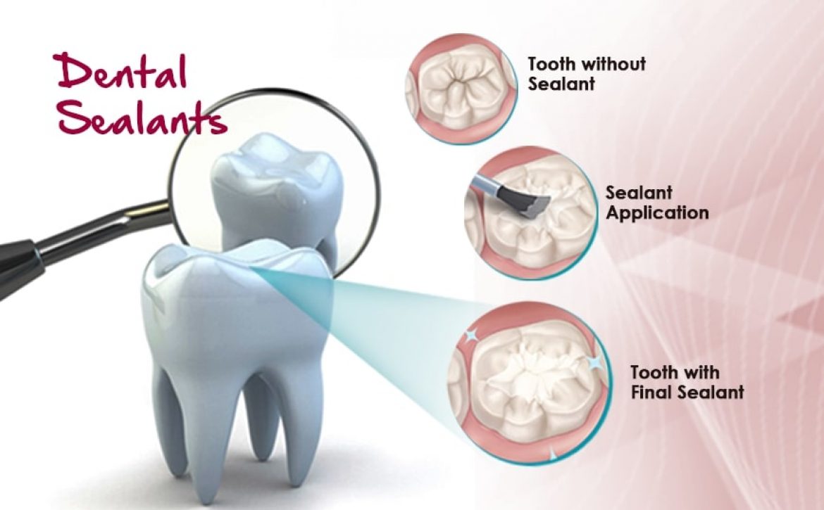 Dental Sealants explained