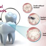 What are Dental Sealants?