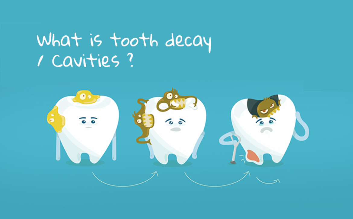 tooth decay or cavities