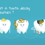 What is tooth decay / Cavities?