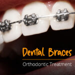 Dental Braces | Orthodontics in Nairobi