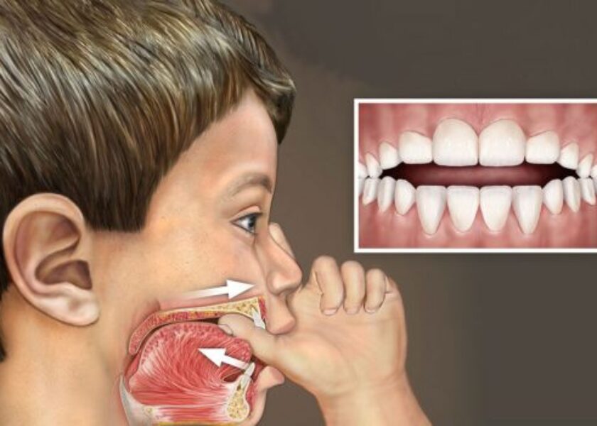 World-Pediatric-Dental-Thumb-Sucking-580×351