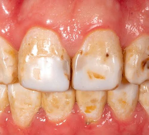 fluorosis fluorosis